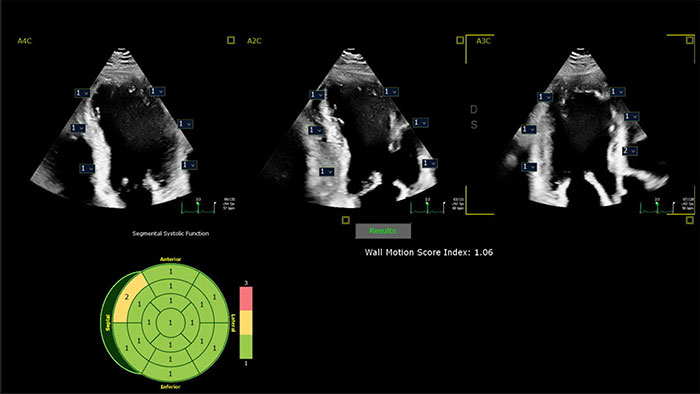 New study shows AI performs as well as expert echocardiographers at recognizing abnormal heart wall movement